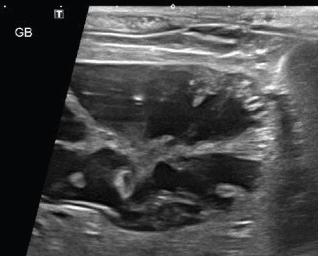 담낭점액종 진단 예시 이미지