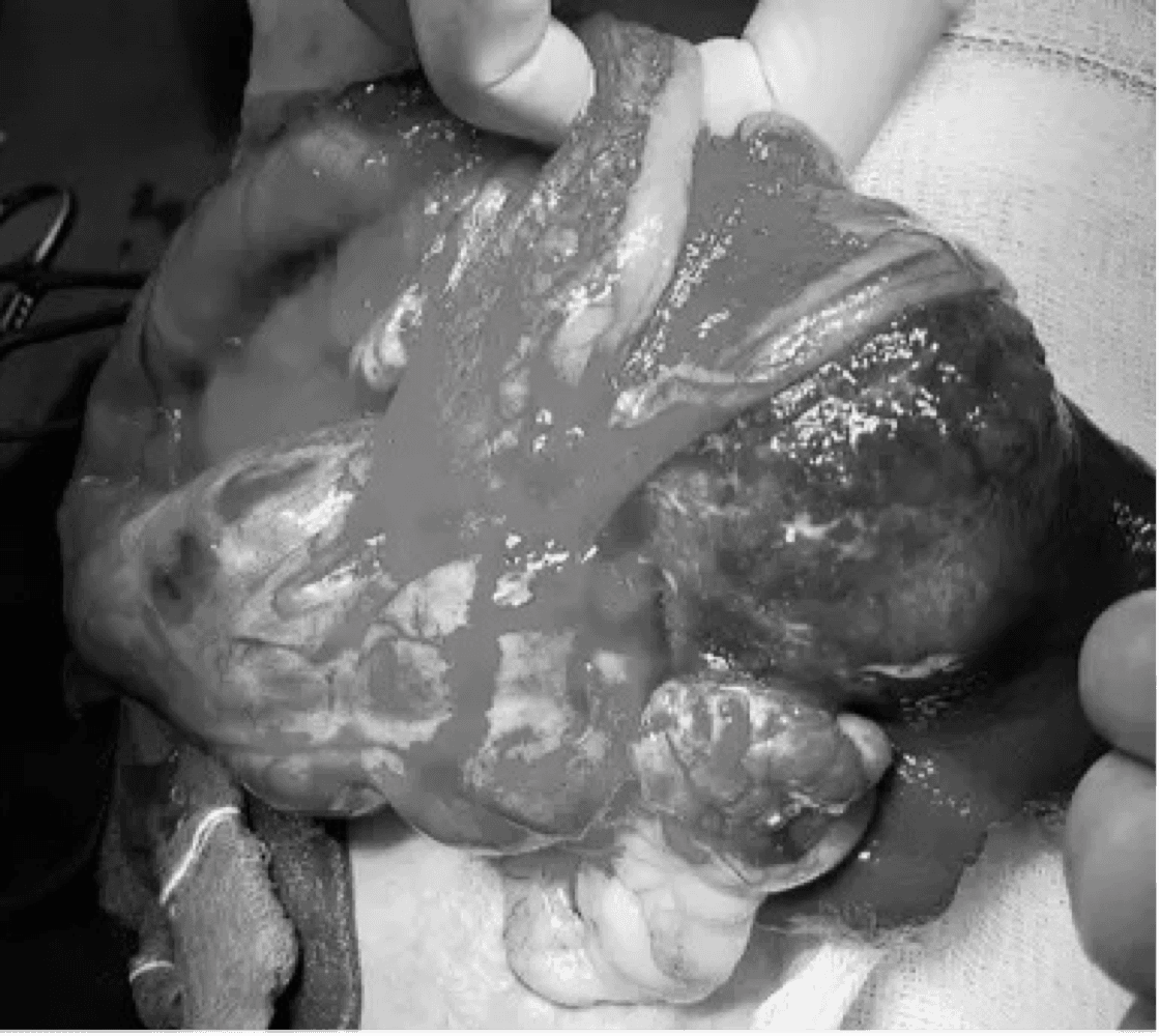 종양 치료 예시 이미지 2