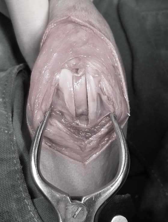 슬개골 탈구 및 DFO 수술 예시 이미지 1