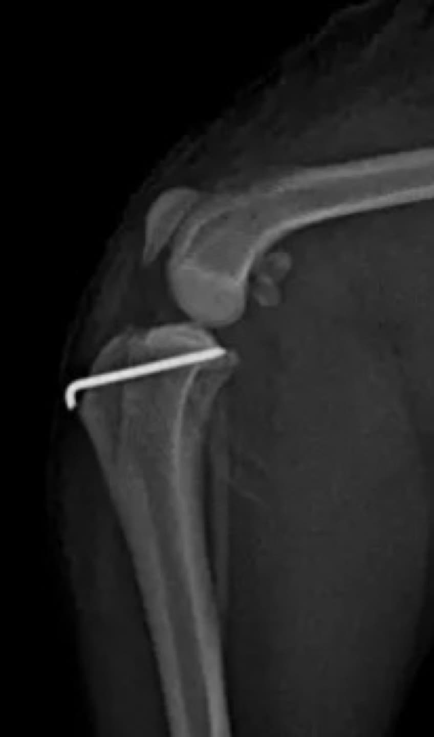 슬개골 탈구 및 DFO 수술 예시 이미지 2