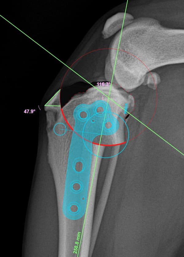 십자인대교정 TPLO 수술 예시 이미지